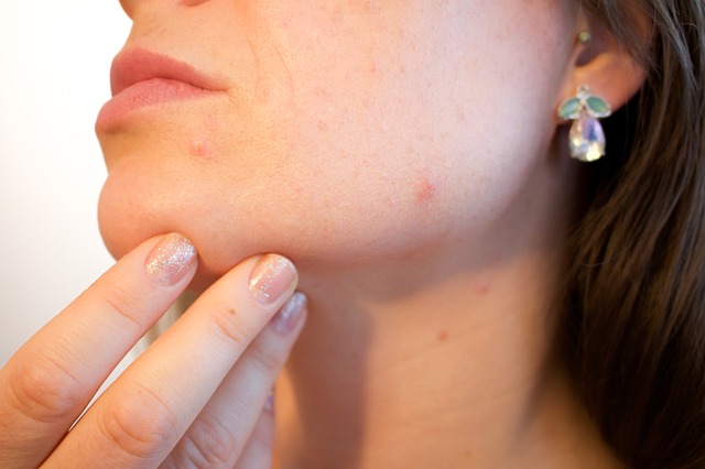 Ako sa zbaviť akné na tvári a tele